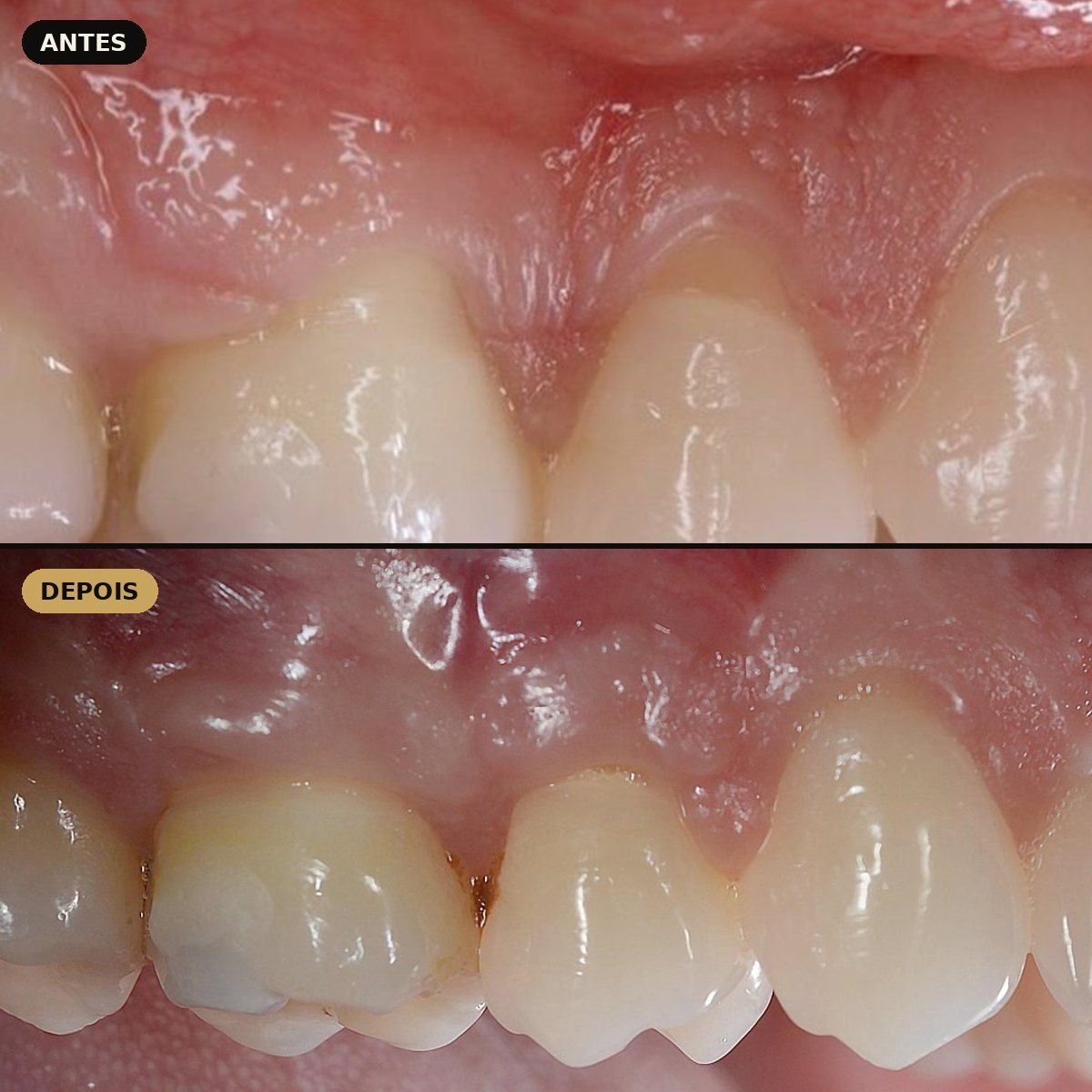 Antes e depois de recobrimento radicular com L-PRF