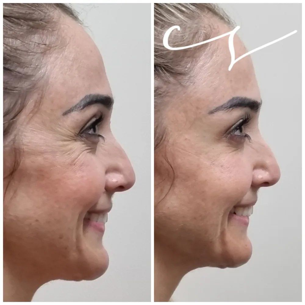 Resultado de toxina botulínica