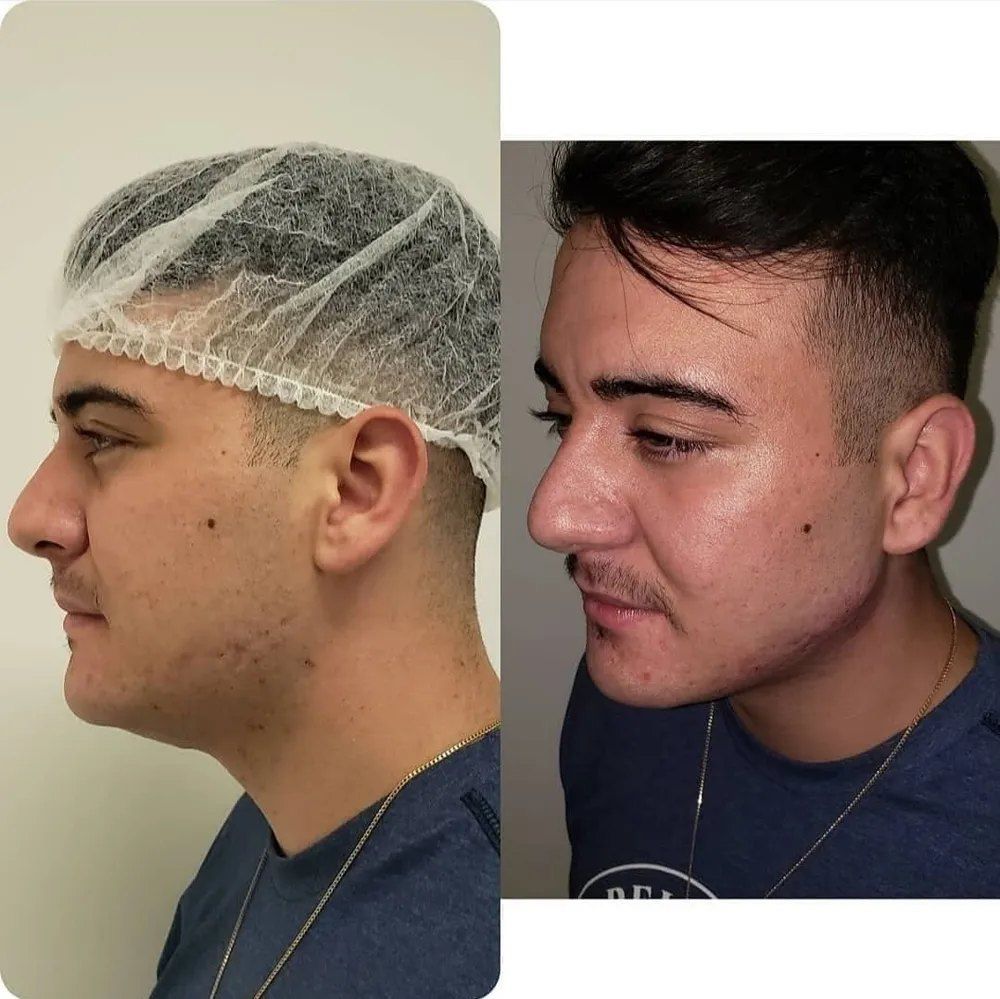 Resultado de harmonização masculina