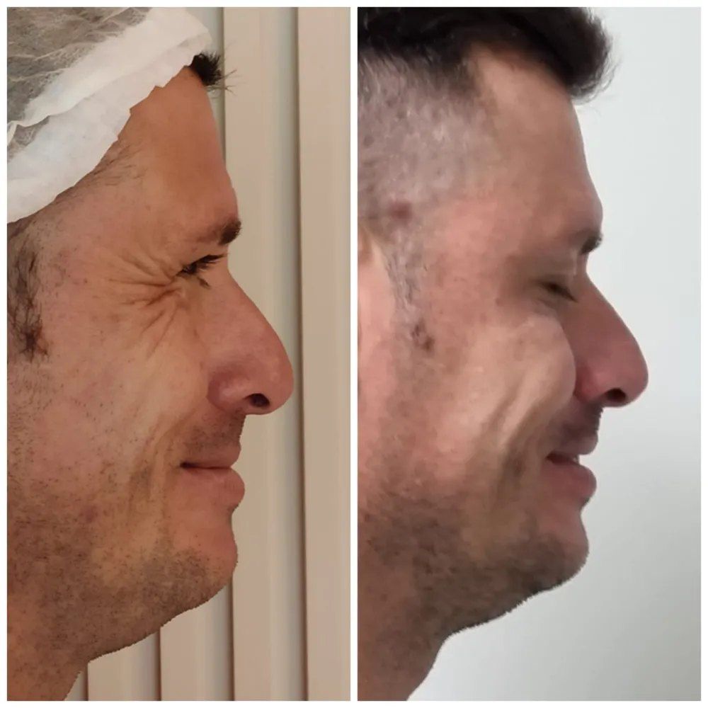 Antes e depois de harmonização masculina