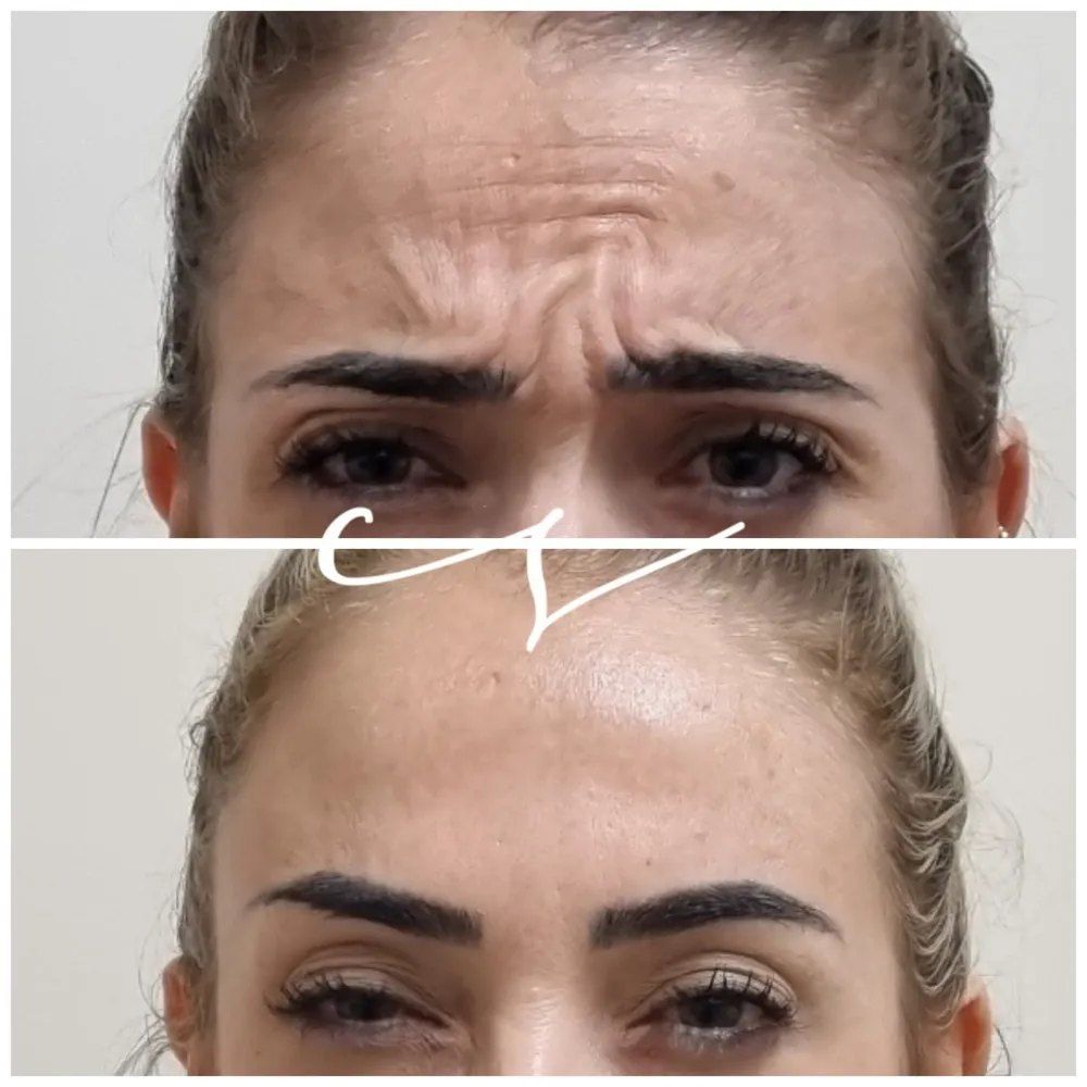 Antes e depois de toxina botulínica na testa