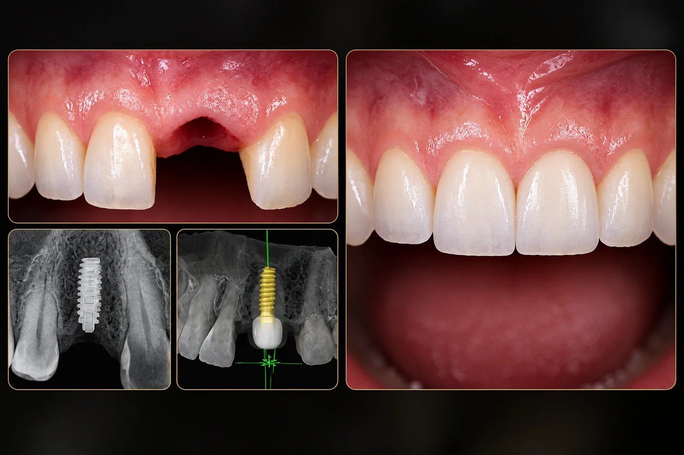 Implante unitário anterior: antes, planejamento digital, radiografia e resultado final