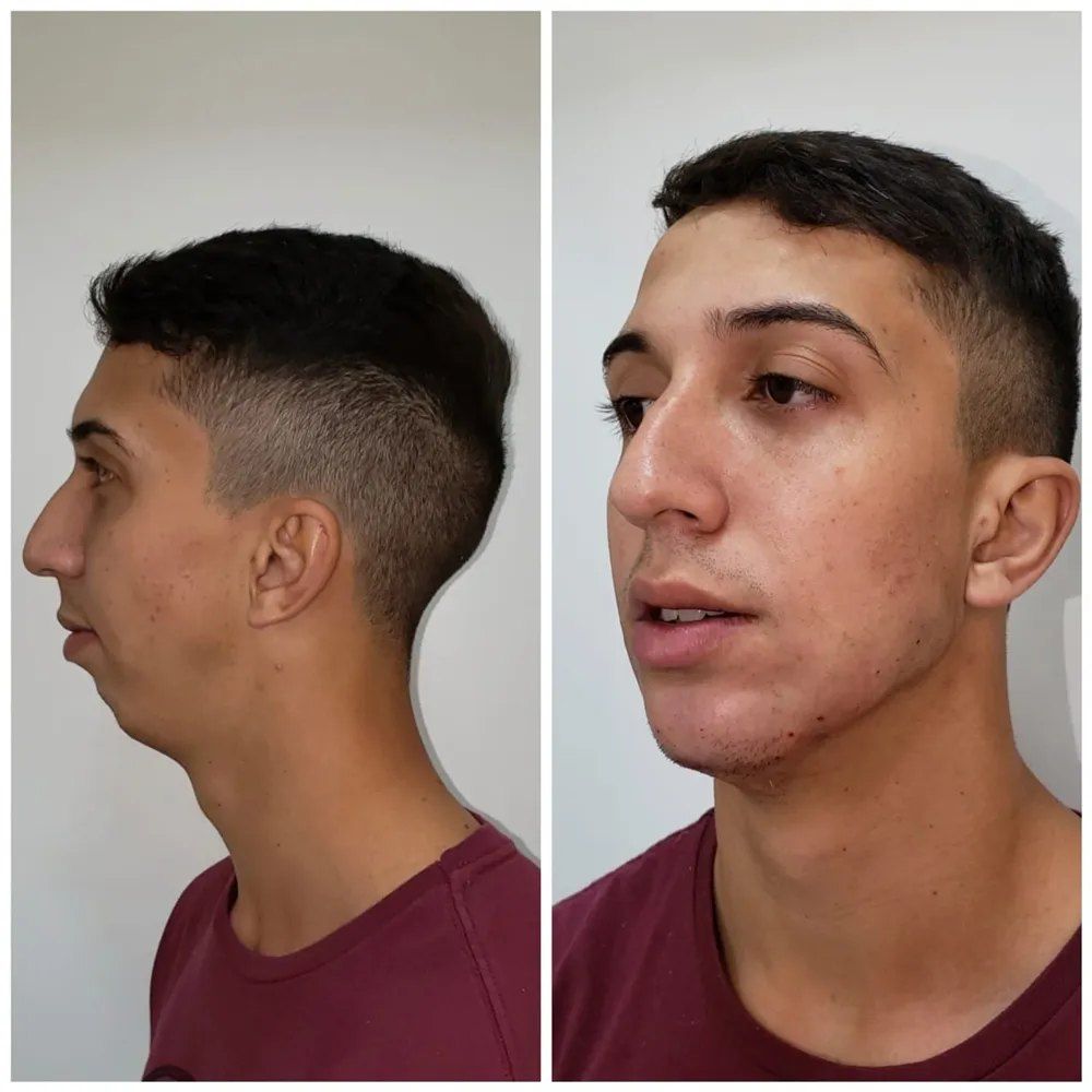 Resultado de harmonização masculina