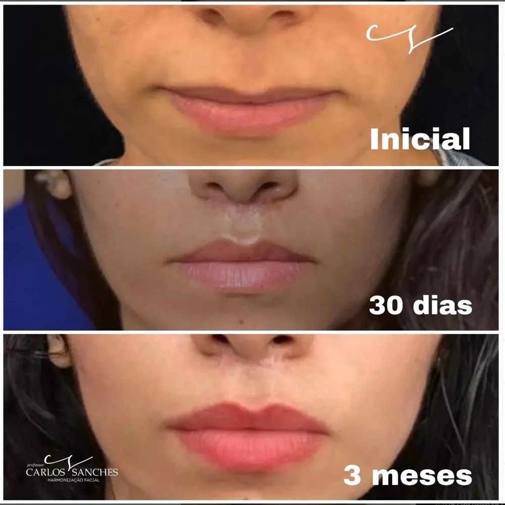 Evolução de lip lift: inicial, 30 dias e 3 meses