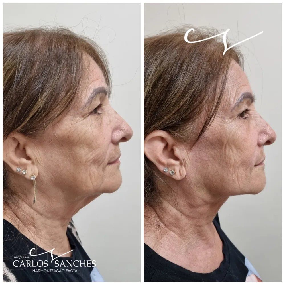Resultado de lipo cérvico-facial