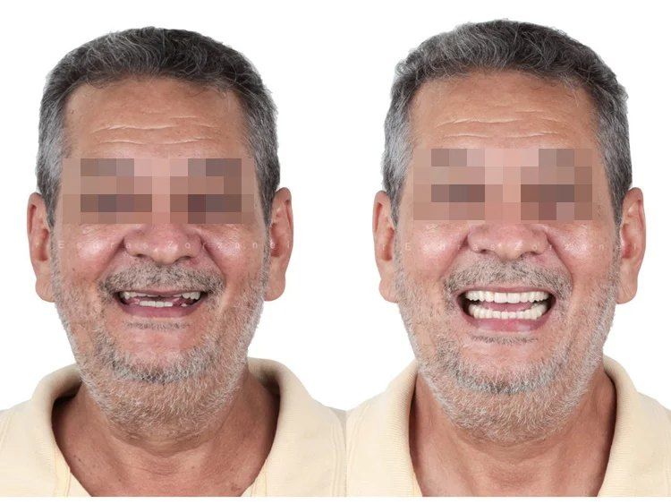 Antes e depois de prótese protocolo dupla sobre implantes