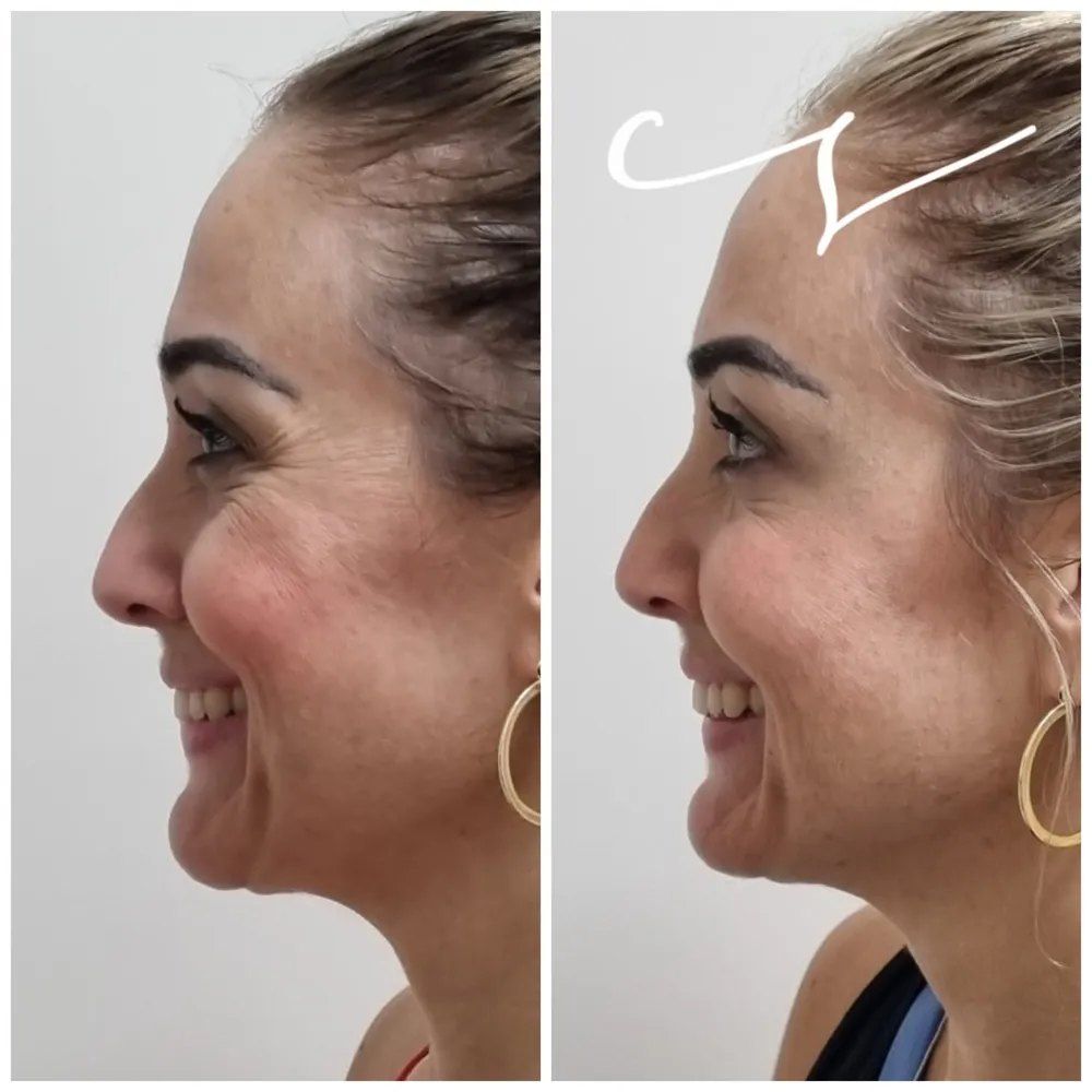 Resultado de toxina botulínica