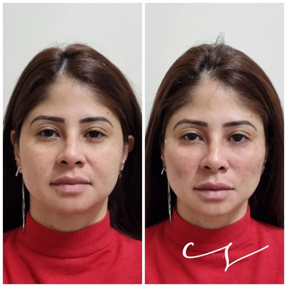 Antes e depois com fios de PDO