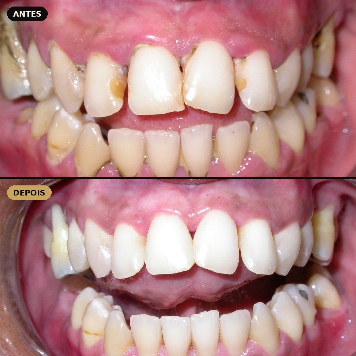 Antes e depois de tratamento periodontal