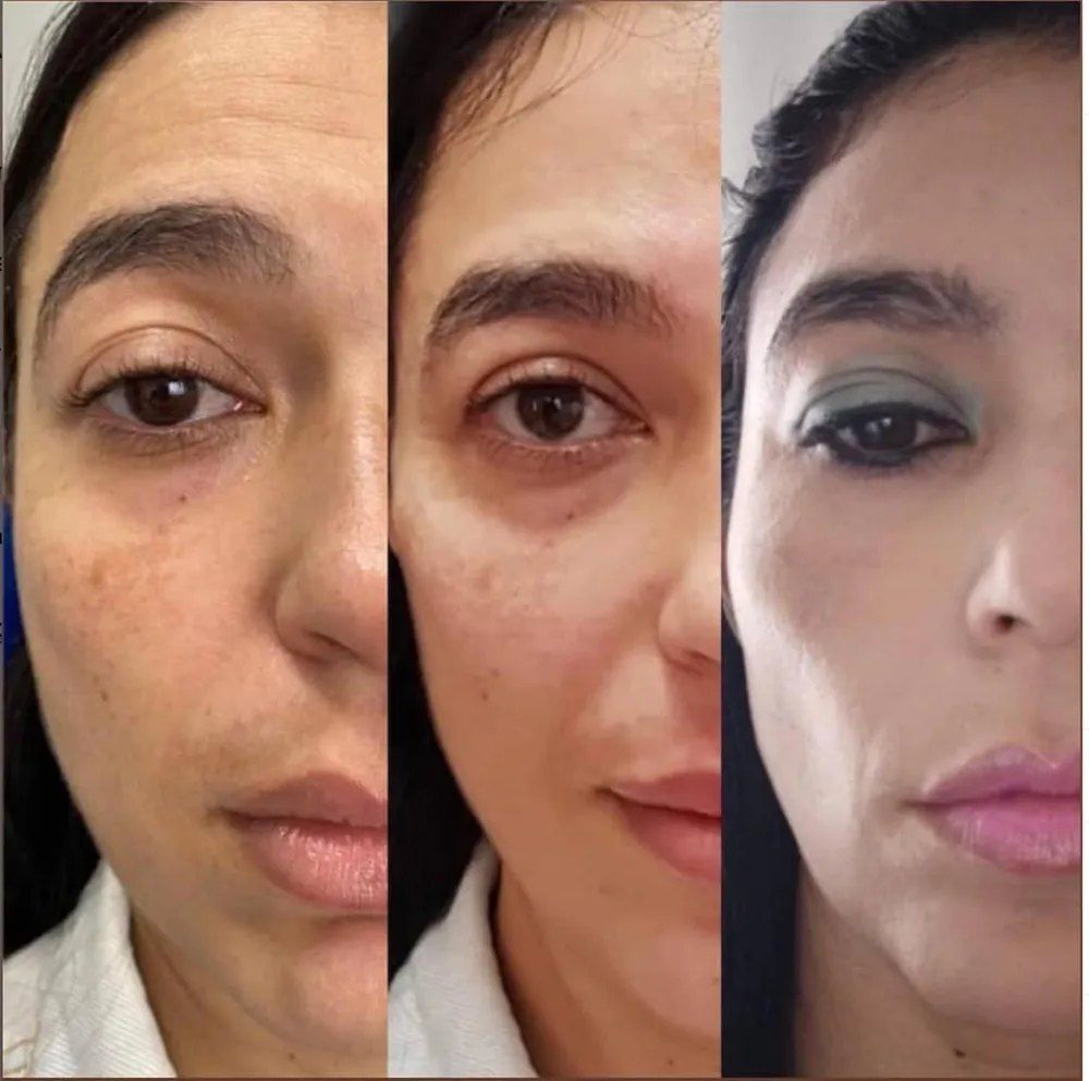 Antes e depois de preenchimento facial